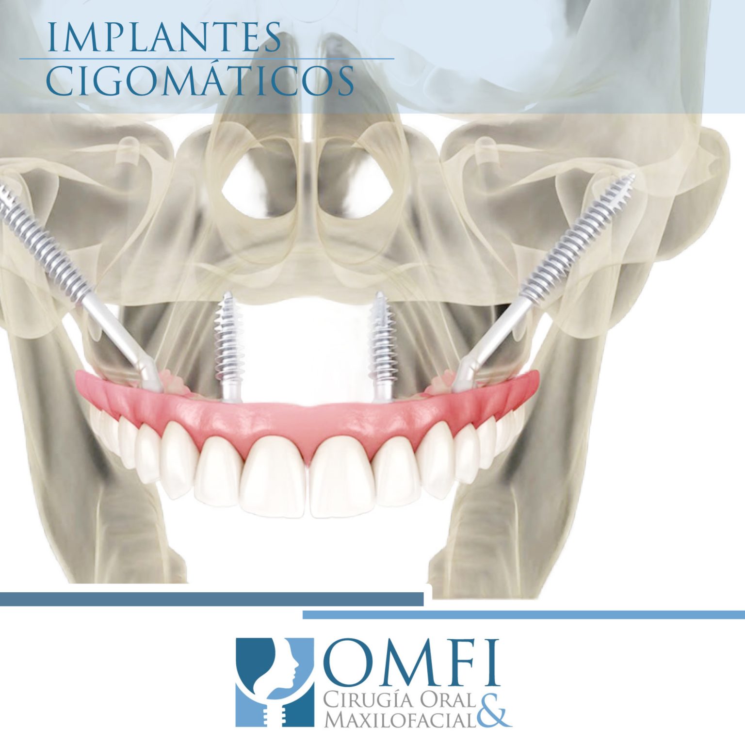 Implantes Dentales Cigom Ticos Omfi