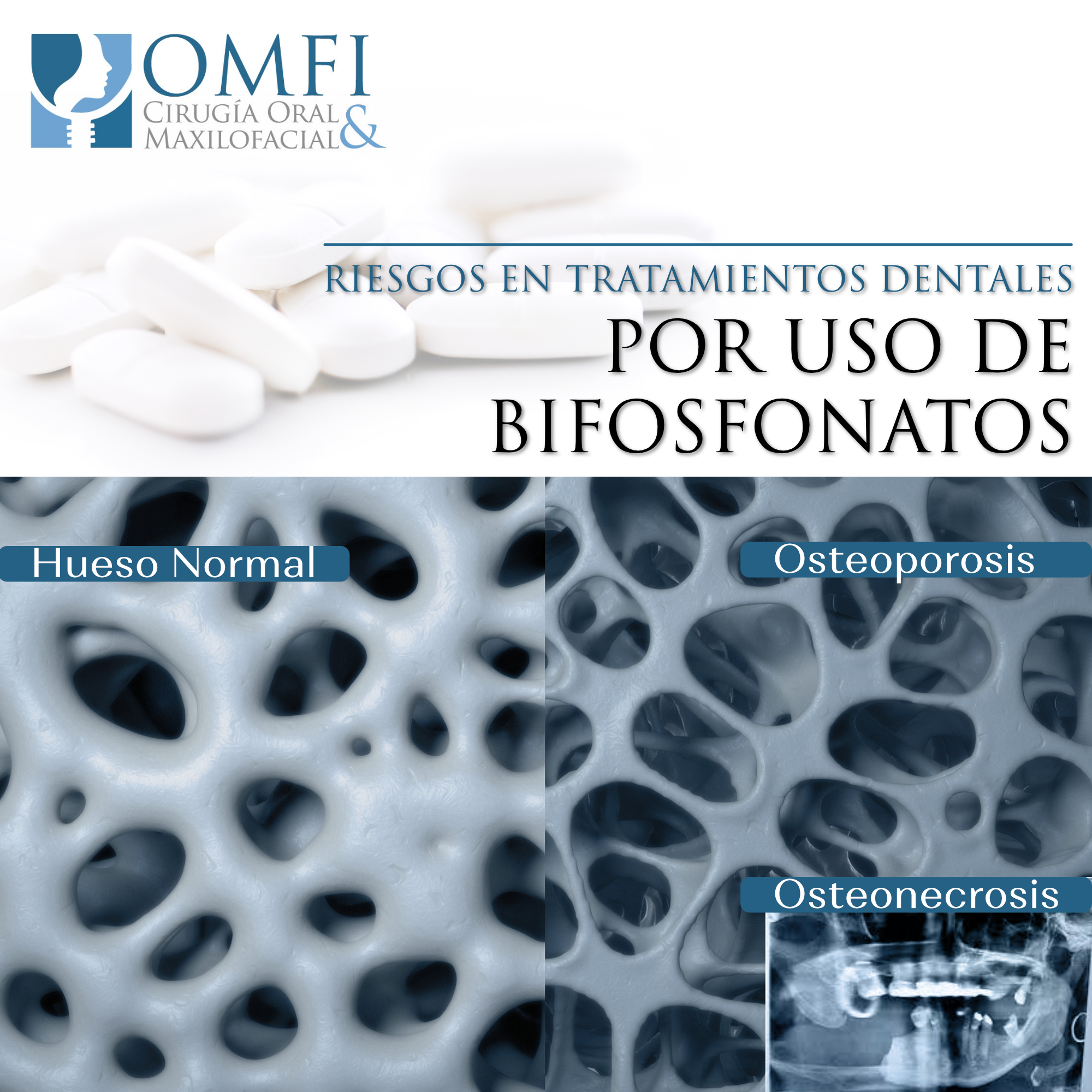 Bifosfonatos OMFI