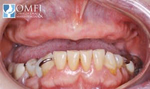 La ausencia de dentadura tiene solución con los implantes All-on-4 y All-on-6