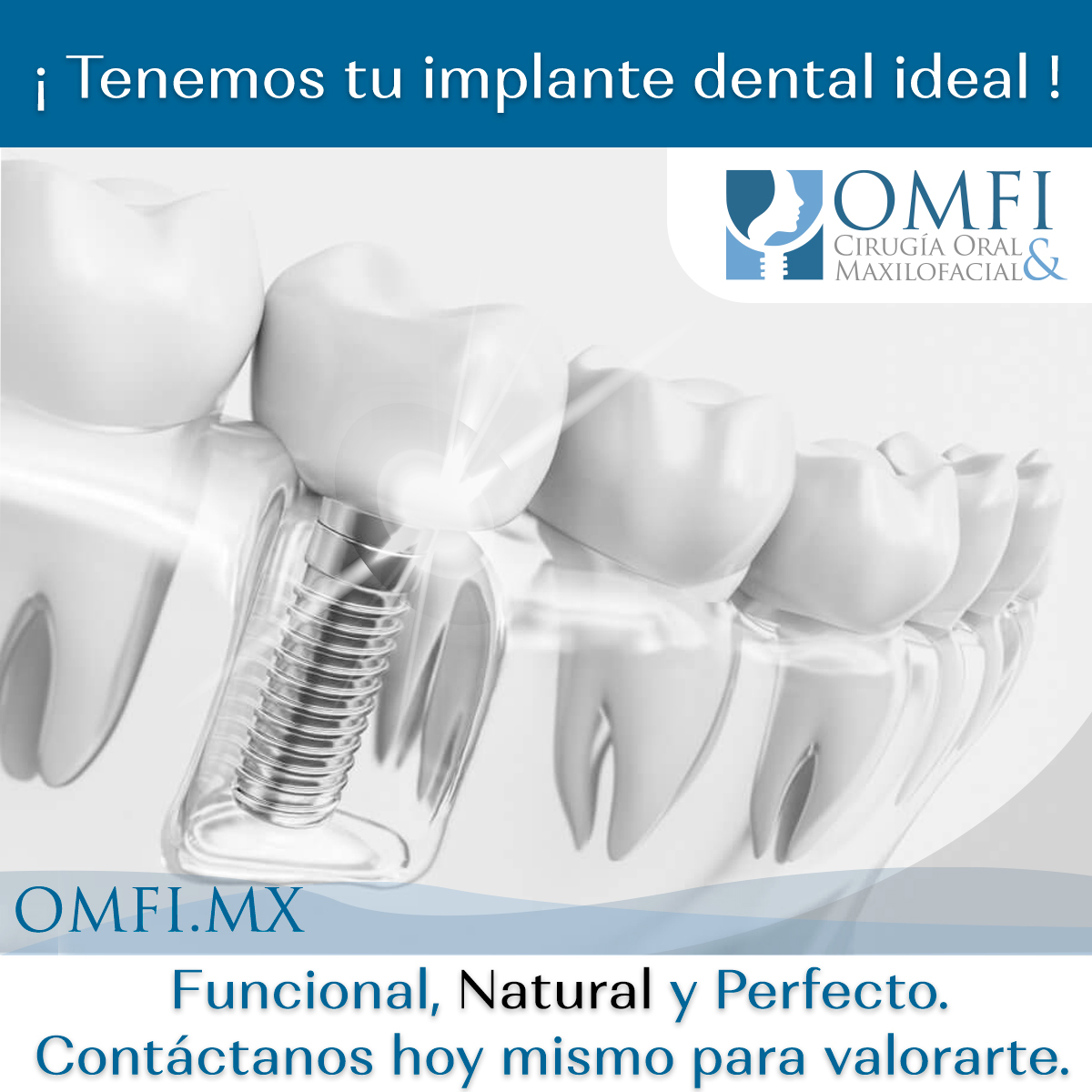 Implantes Dentales – OMFI