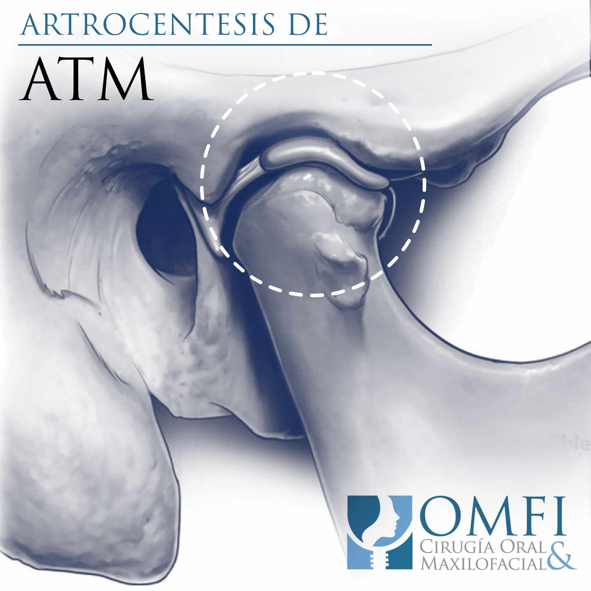 artrocentesis