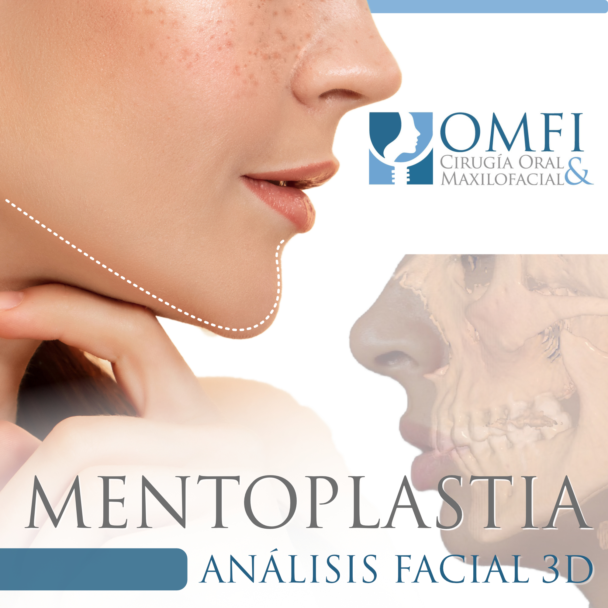 mentoplastia